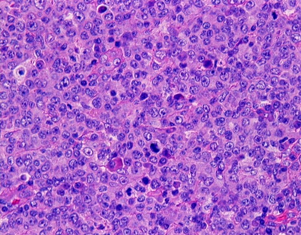 Imagen de Ganglio linftico cervical en mujer de 57 aos / Cervical lymph node in 57 years old female.