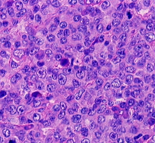 Imagen de Ganglio linftico cervical en mujer de 57 aos / Cervical lymph node in 57 years old female.