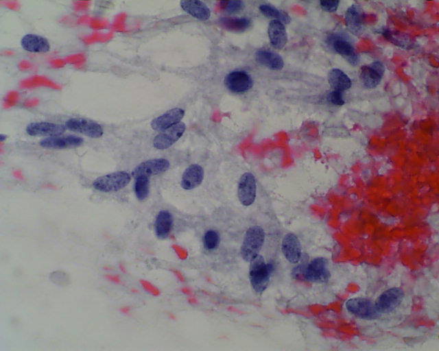 Imagen de Puncin aspiracin de ndulo tiroideo en mujer de 49 aos/Fine needle aspiration cytology of thyroid nodule in 49 years old female