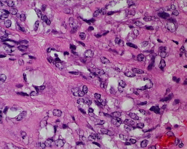 Imagen de Puncin aspiracin de ndulo tiroideo en mujer de 49 aos/Fine needle aspiration cytology of thyroid nodule in 49 years old female