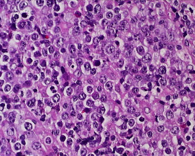 Imagen de Ganglio linftico laterocervical en varn de 75 aos/Lateral cervical lymph node in 75 years old male.