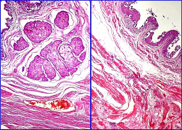 Imagen de Tumor cstico mediastinal/Cystic mediastinal tumor