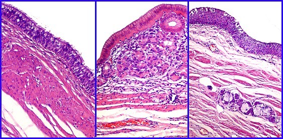 Imagen de Tumor cstico mediastinal/Cystic mediastinal tumor