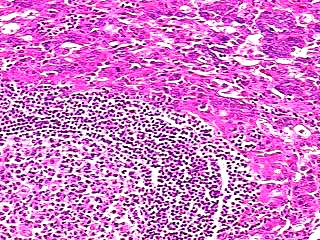 Imagen de PAAF, tumor da regio parotdea.  FNA - Parotidean mass