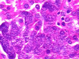 Imagen de PAAF, tumor da regio parotdea.  FNA - Parotidean mass