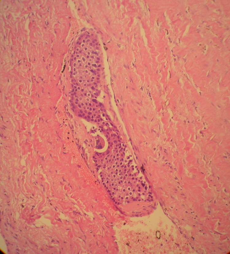 Imagen de Agoaspirato di nodulo tiroideo in un uomo di 52 anni / Fine needle aspiration cytology of a thyroid nodule in a 52 years-old man