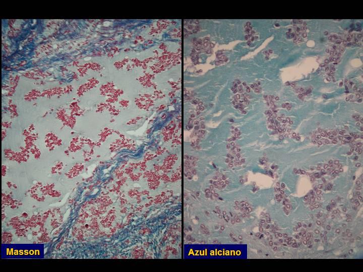 Imagen de Tumor de partes blandas en mujer de 50 aos / Soft tissue tumor in 50 years old female