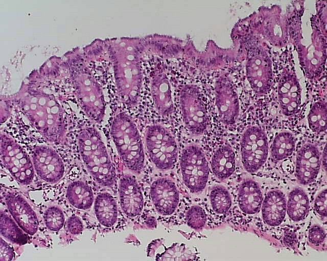 Imagen de Diarrea cronica en varn de 43 aos / Chronic diarrhoea in 43 years old male.