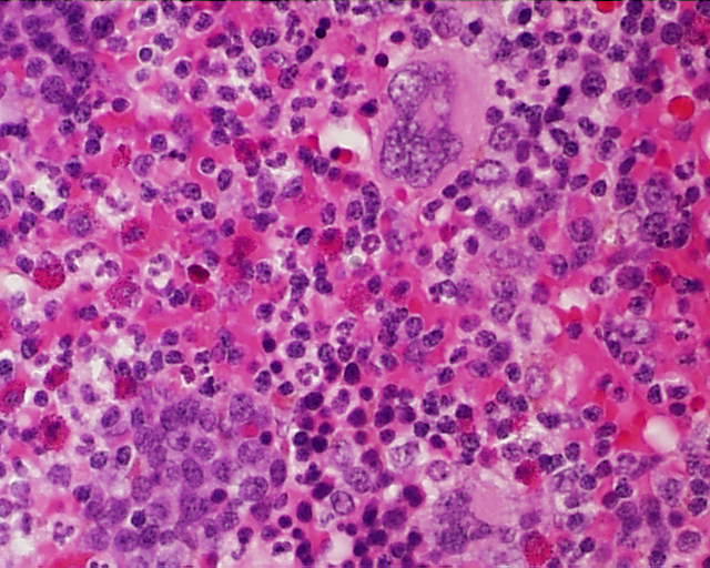 Imagen de Tumor retroperitoneal en varn de 53 aos / Retroperitoneal tumor in 53 years old male.
