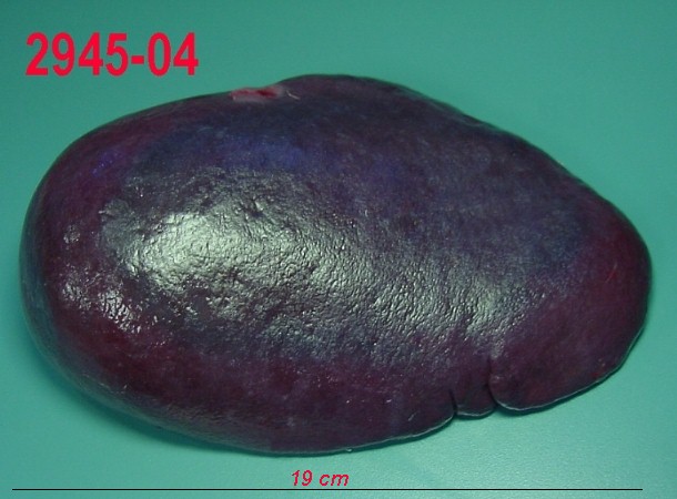 Imagen de Leso de bao, qual a histria? Spleen lesion, what is the history?