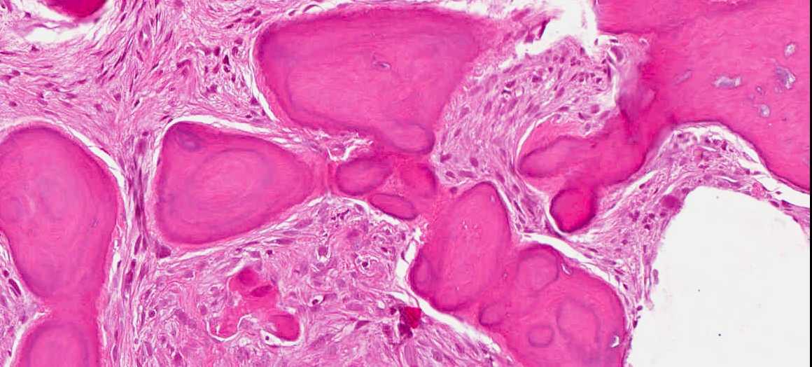 Imagen de Lesin radiolcida mandibular en mujer de 53 aos/Mandibular radiolucent lesion in 53 years old female.
