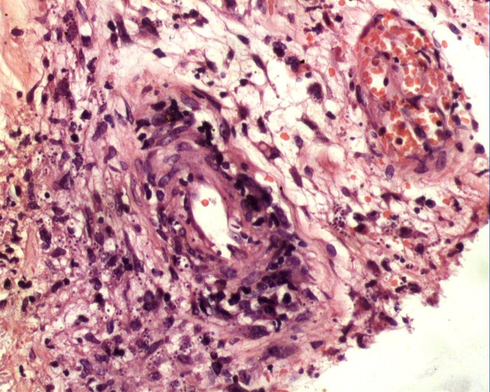 Imagen de Lesin cutnea eritematosa en paciente inmunodeprimida/Cutaneous erythematous lesion in an immunocompromised patient.