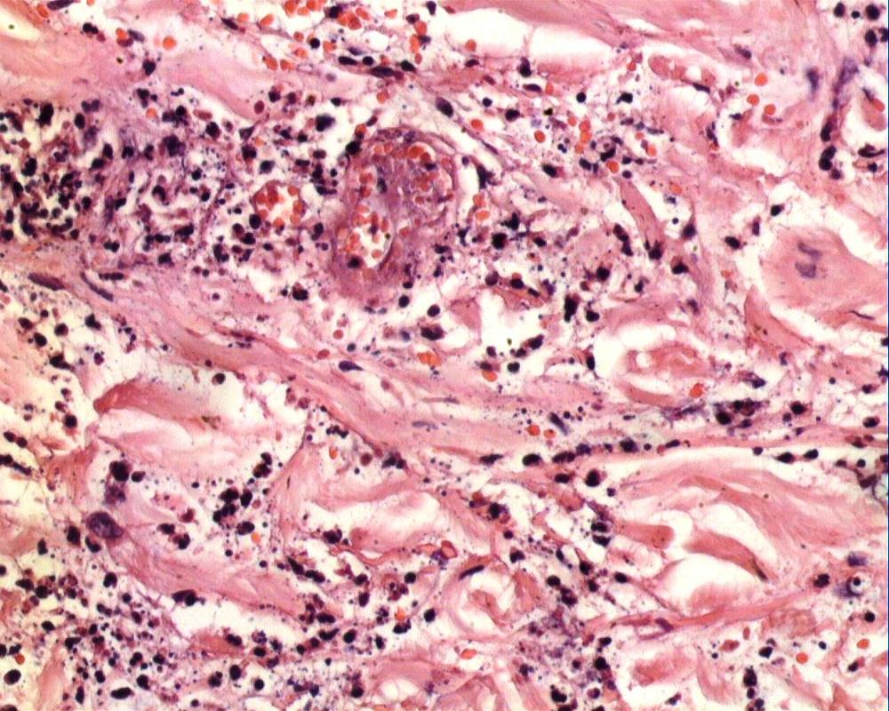 Imagen de Lesin cutnea eritematosa en paciente inmunodeprimida/Cutaneous erythematous lesion in an immunocompromised patient.