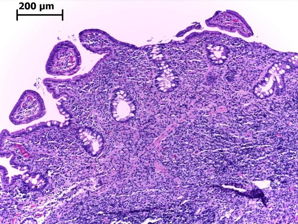 Imagen de Lesin infiltrativa gstrica/gastric infiltrating lesion