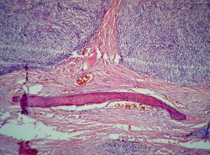 Imagen de TUMOR DE CAVIDAD ABDOMINAL EN MUJER DE 28 AOS./ Tumor of the Abdominal Cavity in a Woman of 28 year old.