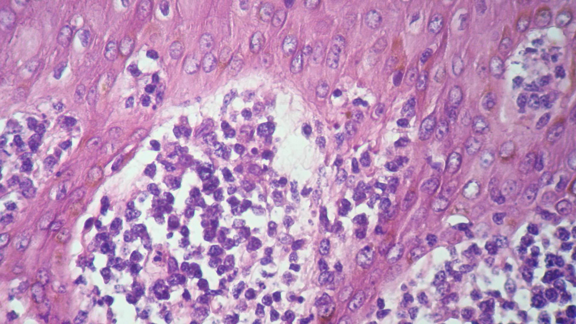 Imagen de Tumores Cutneos Mltilples en Paciente Masculino con antecedente de Tumor Testicular.