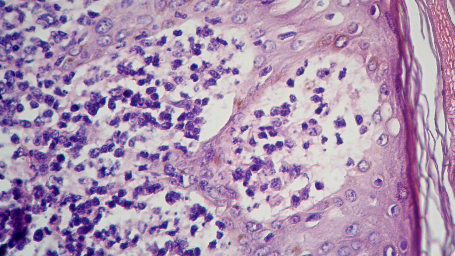 Imagen de Tumores Cutneos Mltilples en Paciente Masculino con antecedente de Tumor Testicular.