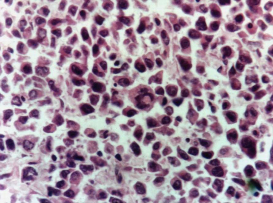 Imagen de Tumor Intestinal en Paciente Masculino de 18 Aos de Edad. 