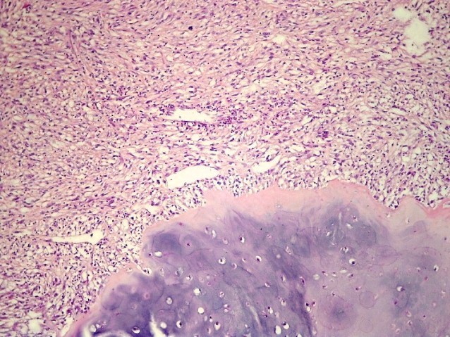 Imagen de Tumor do mero. Umeral tumor.