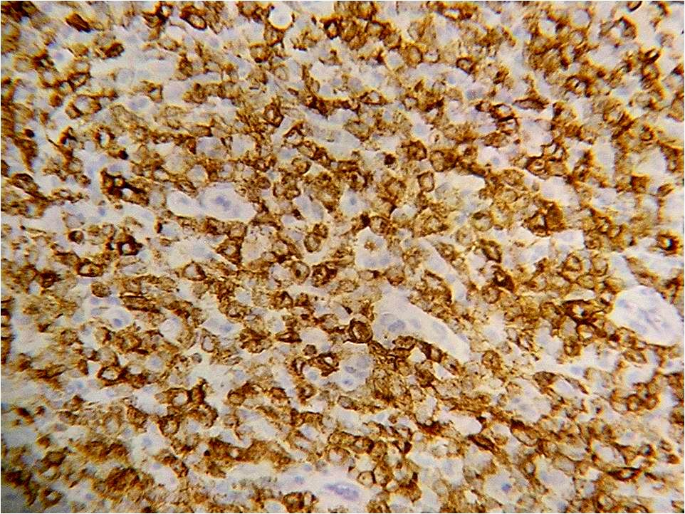 Imagen de Tumor Intestinal en Paciente Masculino de 18 Aos de Edad. 