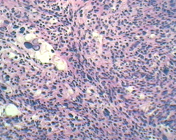 Imagen de Tumor de partes blandas en varn de 43 aos / Soft tissue tumor in 43 years old male.