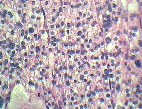 Imagen de Tumor de partes blandas en varn de 43 aos / Soft tissue tumor in 43 years old male.