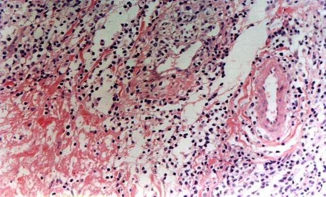 Imagen de Tumoracin subcutnea ltero-cervical / Subcutaneous lateral cervical tumor.