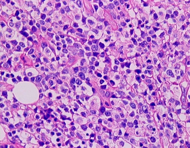 Imagen de Tumoracin subcutnea ltero-cervical / Subcutaneous lateral cervical tumor.
