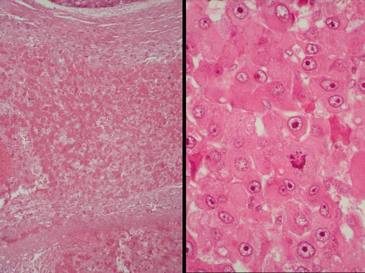 Imagen de Tumor intracraneal en varn de 80 aos / Intracraneal tumor in 80 years old male.