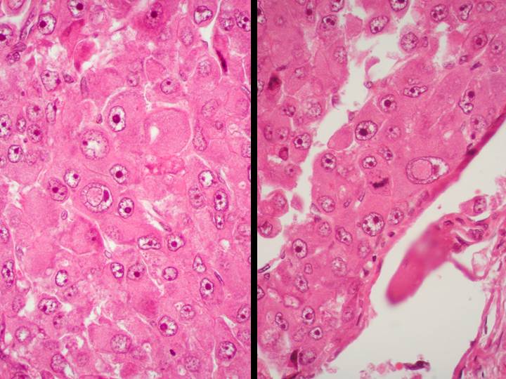 Imagen de Tumor intracraneal en varn de 80 aos / Intracraneal tumor in 80 years old male.