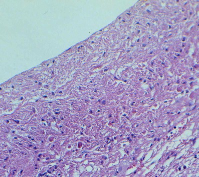 Imagen de Tumor de SNC / CNS tumor