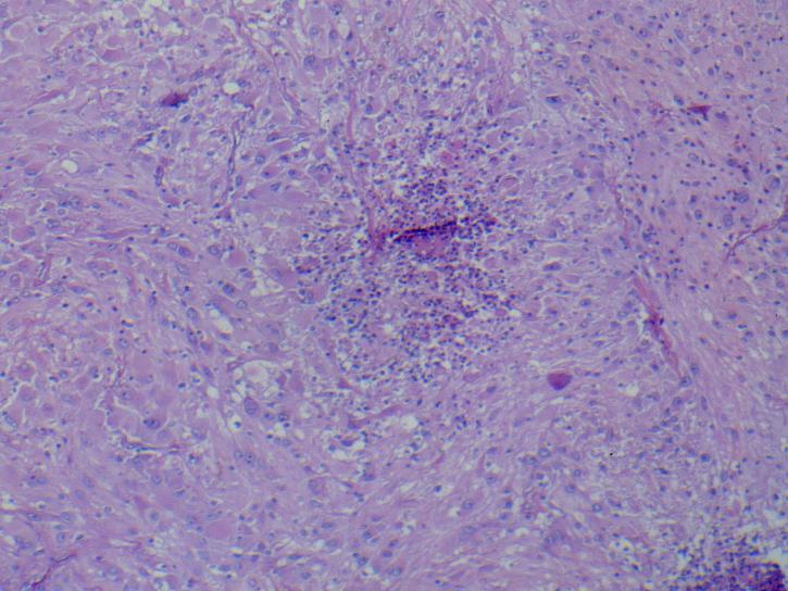 Imagen de Tumor de SNC / CNS tumor
