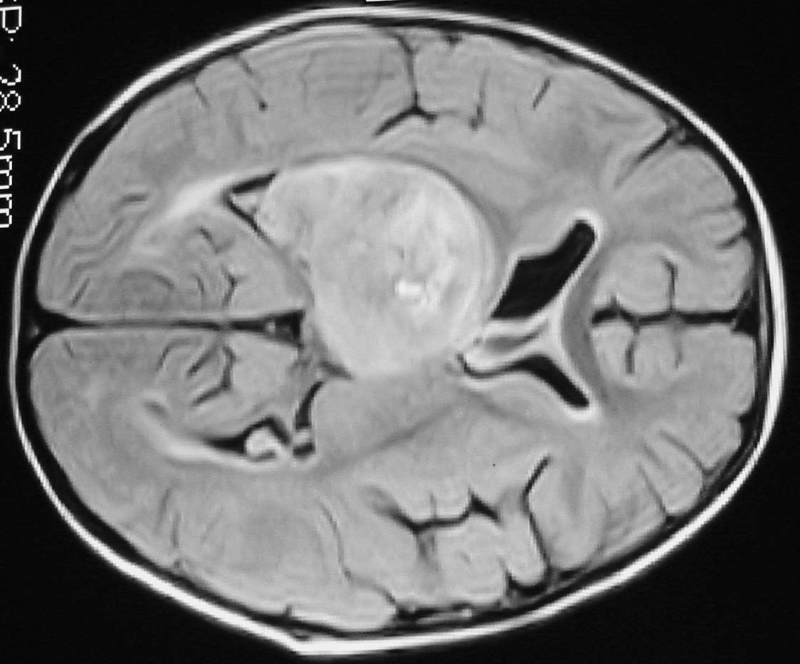 Imagen de Masa en cuerno posterior de ventrculo izquierdo / Posterior horn left lateral ventricle mass.