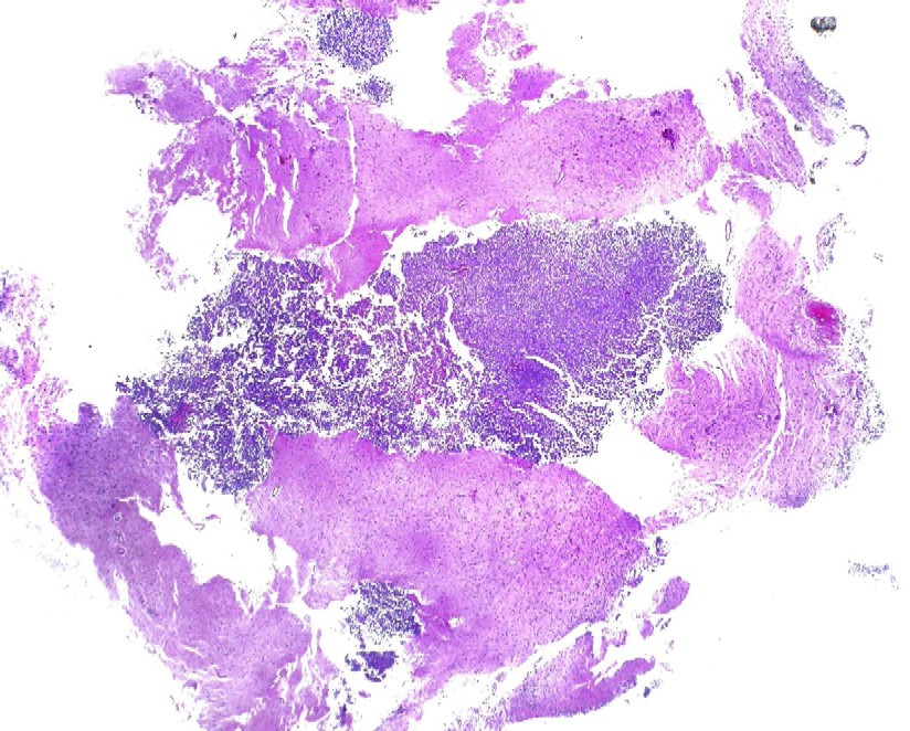 Imagen de Masa en cuerno posterior de ventrculo izquierdo / Posterior horn left lateral ventricle mass.