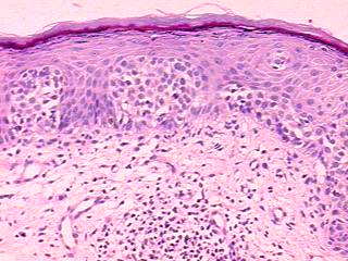 Imagen de Leso cutnea extensa em homem de 68 anos/ Extensive cutaneous lesion in a 68 years old man