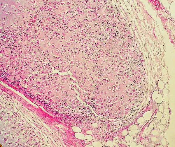 Imagen de Nodular lesion in the left parotid gland region / Lesione nodulare della regione parotidea sinistra