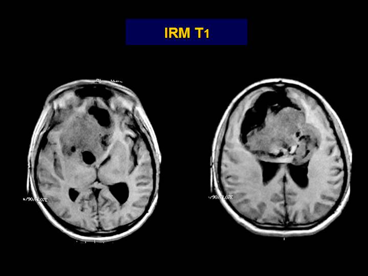 Imagen de Tumor frontal en paciente joven / Frontal tumor in young patient