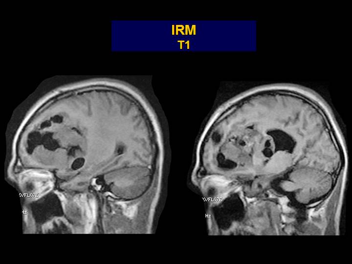 Imagen de Tumor frontal en paciente joven / Frontal tumor in young patient