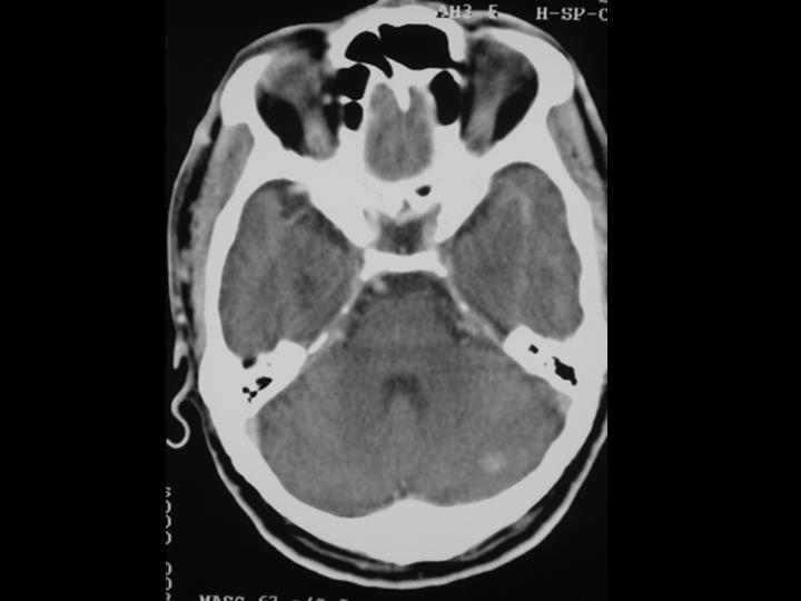 Imagen de Lesin nodular en regin infra-auricular / Nodular  lesion in the  retro-auricular region
