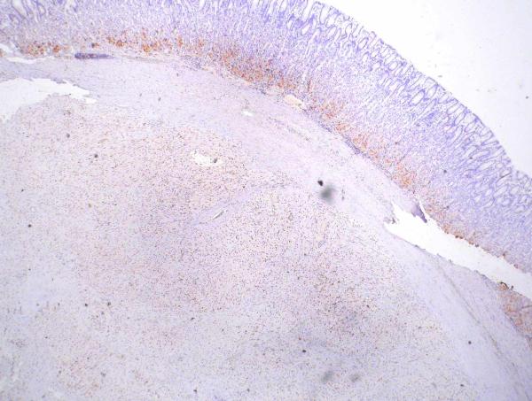 Imagen de Tumor en pared posterior de estmago /  Tumor in posterior wall of stomach body
