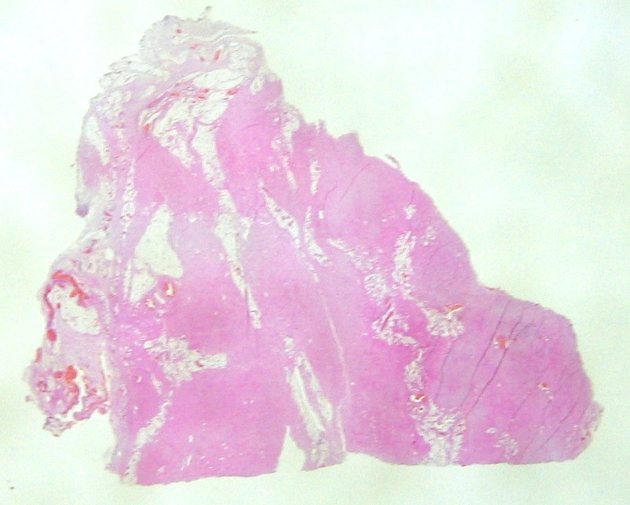 Imagen de Tumor de partes blandas en la espalda / Soft tissue tumor in the back.