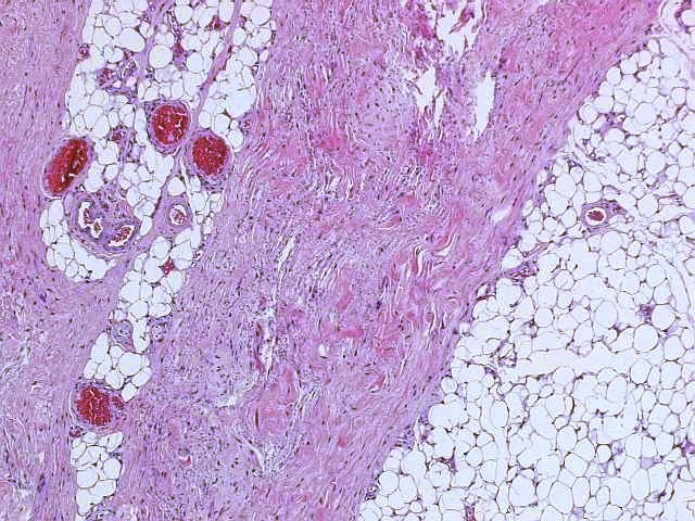 Imagen de Tumor de partes blandas en la espalda / Soft tissue tumor in the back.