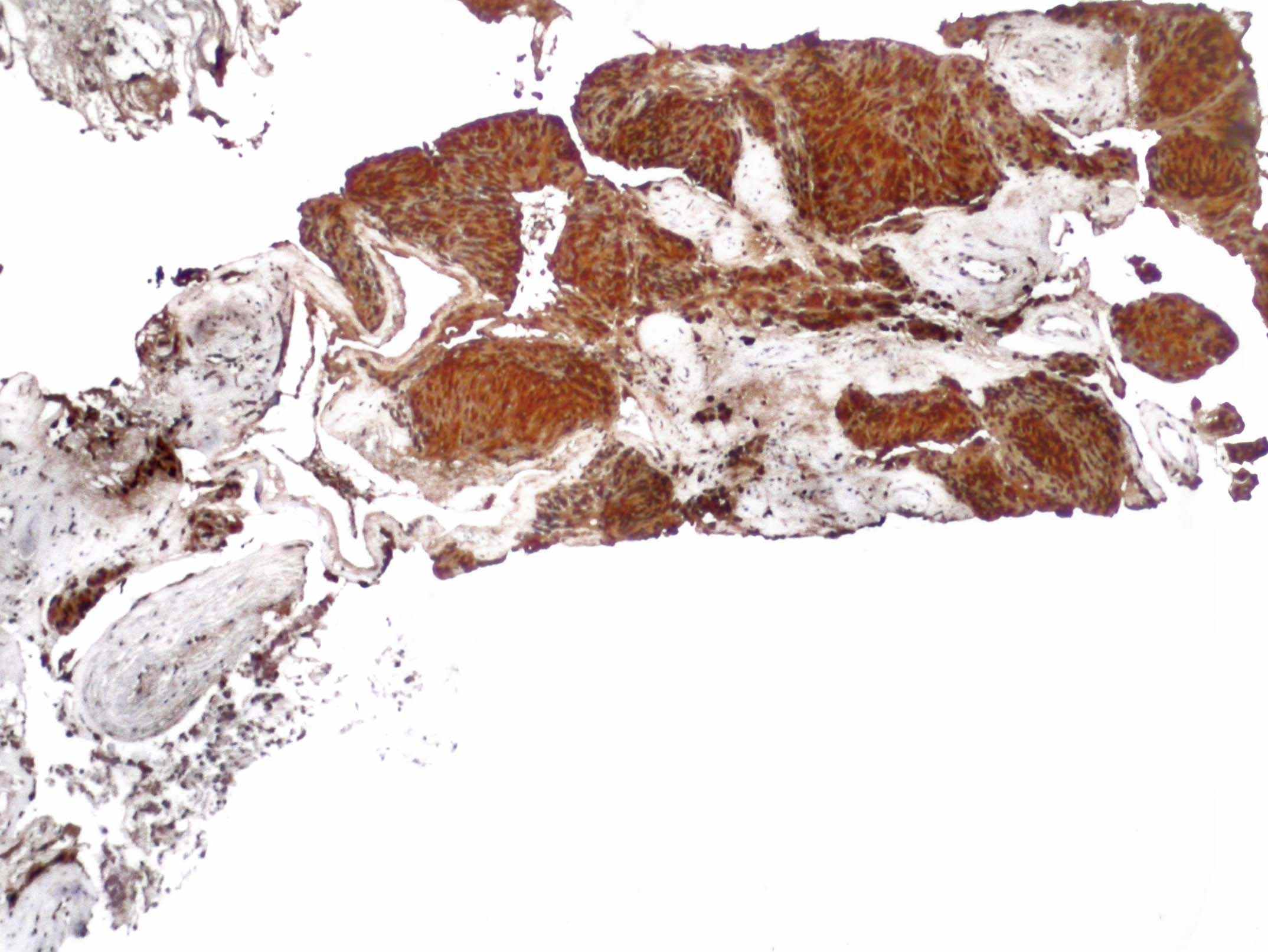 Imagen de Neoplasia Inusual en Biopsias Transrectales de Prstata / Uncommon  Prostatic Neoplasia On transrectal Biopsies.