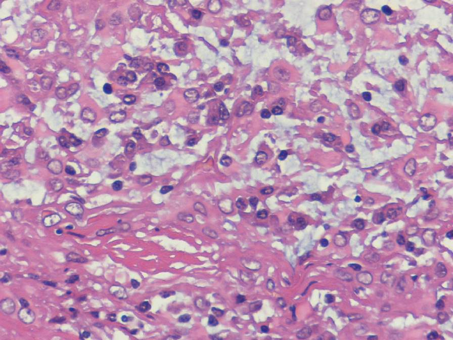 Imagen de Tumor intracraneal en mujer de 50 aos / Intracraneal tumor in 50 y-o female.