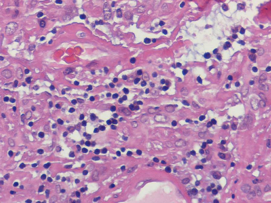 Imagen de Tumor intracraneal en mujer de 50 aos / Intracraneal tumor in 50 y-o female.