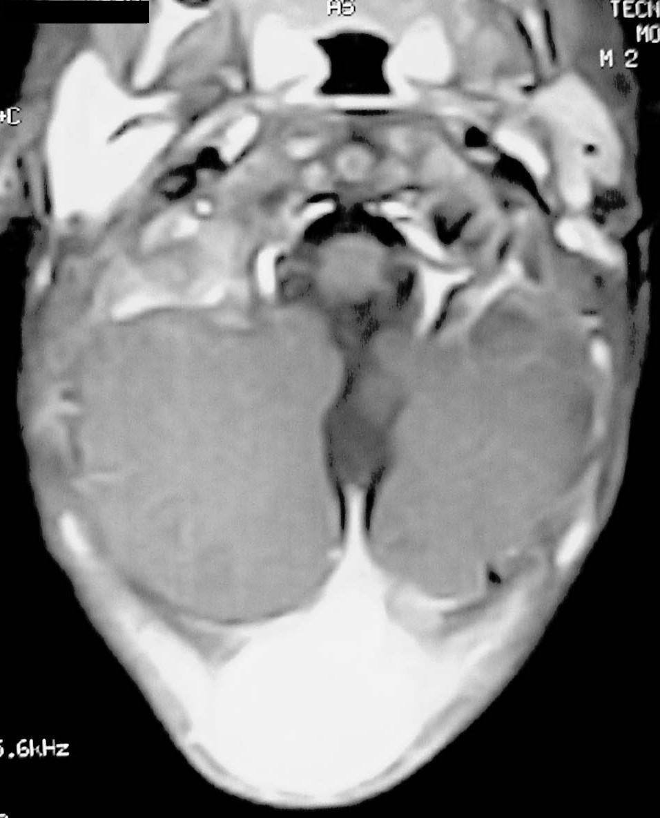 Imagen de Tumor de Menngeo de  Regin Occipital en Nio de 2 aos de edad / Occipital Meningeal Tumor in a Two Year Old Male.