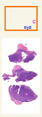 Imagen de Tumor de Menngeo de  Regin Occipital en Nio de 2 aos de edad / Occipital Meningeal Tumor in a Two Year Old Male.
