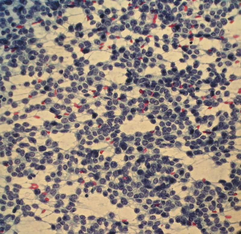Imagen de Fine-needle aspiration cytology of a tumor in the left kidney