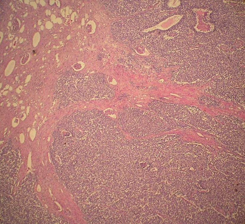 Imagen de Fine-needle aspiration cytology of a tumor in the left kidney