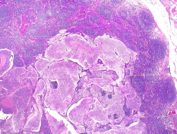 Imagen de Biopsia de ganglios retroperitoneales  /  Retroperitoneal lymph node biopsy